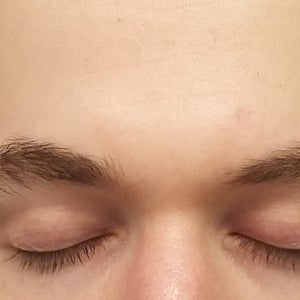 wrinkly eyelids at 18