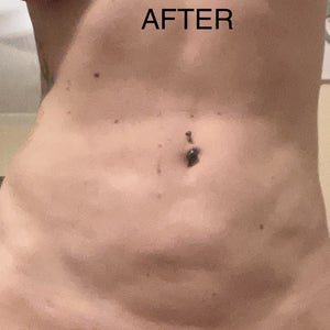 How Will a BBL Affect Your Belly Button?