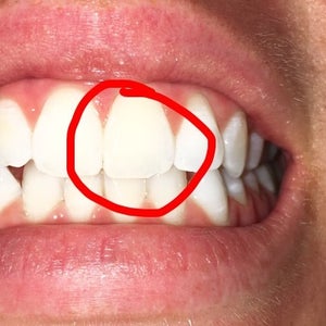 I Chipped My Front Tooth It S Very Small But I Notice It Was Wondering What I Could Do To Fix It Photo