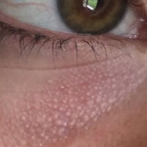 Little white discount bumps under eyes
