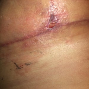 4 Weeks Post Op T Junction Breast Reduction Have Had An Open Wound When Will It Heal Photo