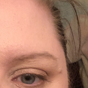 wrinkly eyelids at 18
