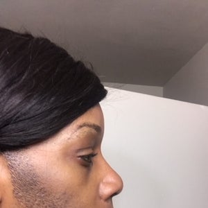 Is It Possible To Do Microneedling And Laser Hair Removal Together Photo