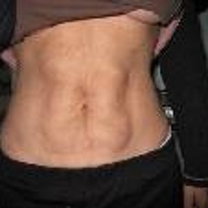 Treatments to Correct Bad Smart Lipo Results?