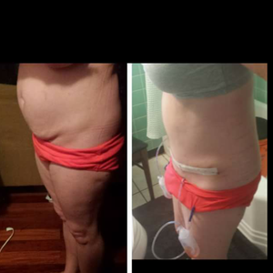 Failed muscle repair from tummy tuck? (Photo)