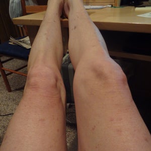 hyperpigmentation cream for legs