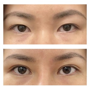 Double Eyelid Surgery Reviews Was it Worth It RealSelf