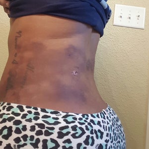 I had a BBL three weeks ago and I have bad scarring/ burns on my lower back  from the lipo. Any suggestions? (photo)