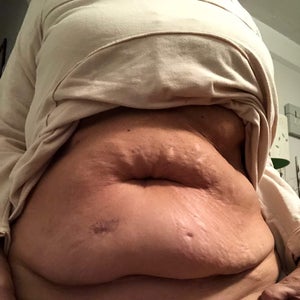 Velashape Reviews, Was it Worth It?