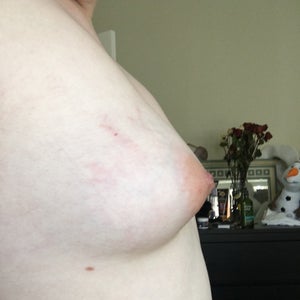 Do I have tubular breasts? Do I need to lose weight before my breast  augmentation consult? (Photo)