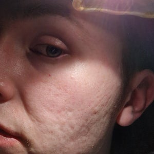 mild acne photos