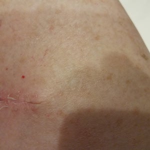 Melanotan Reviews | Was it Worth It? | RealSelf
