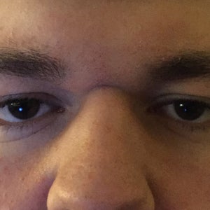 horizontal wrinkle between eyes