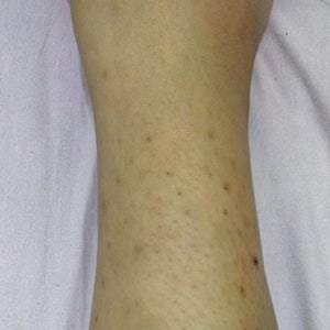 How to get rid of ingrown outlet hair scars