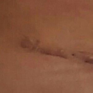 What Was The Popping Noise I Heard When I Massaged My Raised Incision And Why Is It Flat A Few Minutes Later Photos