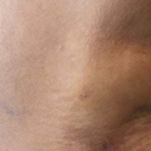 Hard Bulge In Armpit After Liposuction Is This Normal Photo