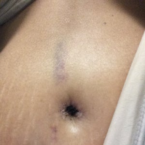 Bruise above Belly Button from sneezing after Lower Body Lift. photo