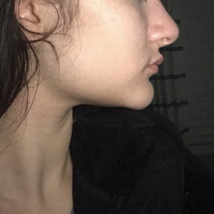 How Can I Fix My Witch Chin Every Time I Smile My Chin Droops Down Photos Chin surgery can change the shape and size of your chin and enhance your jawline.