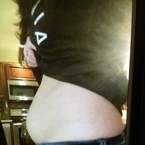 I Got A Mini Tummy Tuck And An Internal Corset Over A Year Ago Photos