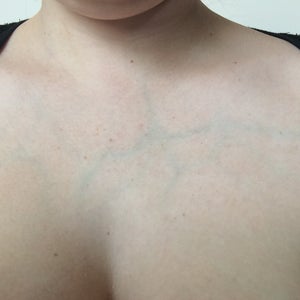 I Have Very Visible Veins All Over My Body Is There Any Way Of Making The Veins On My Chest Less Visible Photo