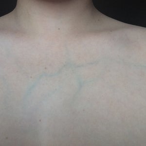 I Have Very Visible Veins All Over My Body Is There Any Way Of Making The Veins On My Chest Less Visible Photo