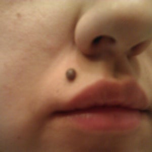 Best Method Of Removal Least Amount Of Scarring For A Large Mole Above Upper Lip Photo realself