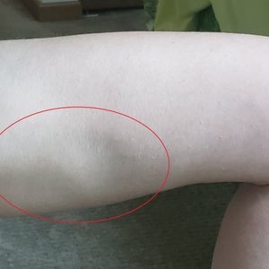 What Is The Best Way To Remedy A Shark Bite On The Inner Thigh Left From Coolsculpting Photos