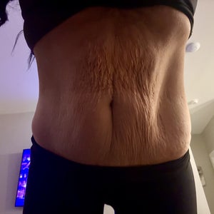 https www.realself.com question lipo-b12-injections-stomach-week Do I have enough skin for a Tummy Tuck? Was told Lipo 360 and Jplasma would  be what's needed. (Photos)