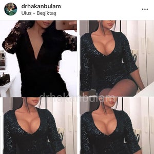 Breast Augmentation Reviews Was It Worth It Realself Page 34