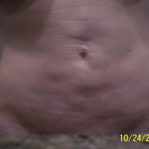 https www.realself.com question lipo-b12-injections-stomach-week Any Advise on Correcting my Stomach After Lipo?
