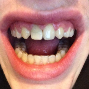 I Got My Braces Off In December And I Haven T Been Wearing My Retainer Is It Too Late To Start Photo