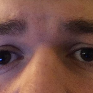 horizontal line between eyebrows