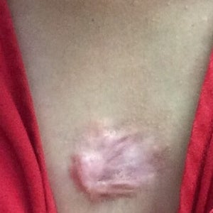 47+ Chest Keloid Scar Tattoo Images