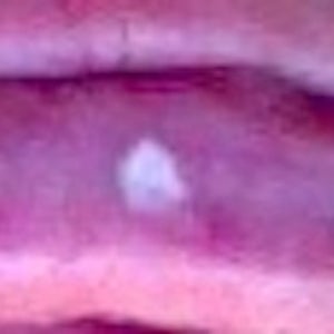 How Can I Remove a White Scar on Lip? (photo)
