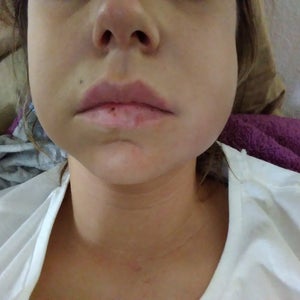 I had buccal fat removal, today would be 2 day post op my left side is very swollen start of infection? (Photo) I had buccal fat removal, today would be 2 day post op my left side is very swollen start of infection? (Photo)