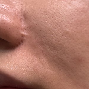 Scar revision post surgery - what would be the best options? (Photo)