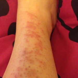 Is it possible to be allergic to laser treatments Photo