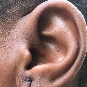 Advanced Homoeo Clinic - Are You Worried about Elongated Ear Lobe