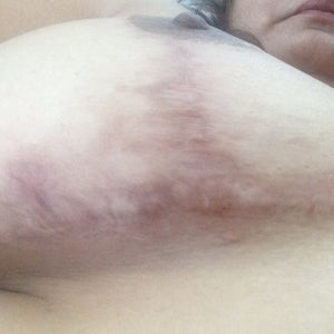 Ugly Breast Photo