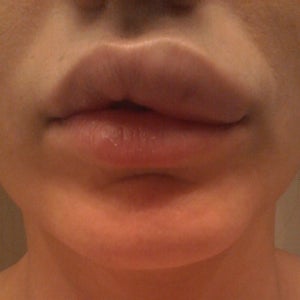 oral melanotic macule icd10 Differential Diagnosis of Pigmented Lesions in the Oral Mucosa: A Clinical  Based Overview and Narrative Review