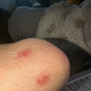 can you burn a wart off with a cigarette How do I heal a chemical burn scar with warts in it? (photo)