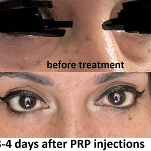 Prp Under Eyes Reviews