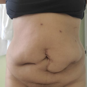 Who Is a Good Candidate for a Tummy Tuck? - Bachelor, Eric