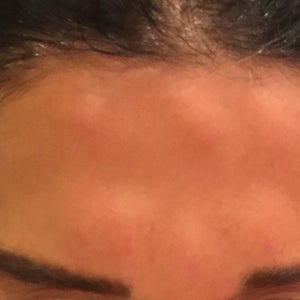 Sore lumps on forehead after Botox injections! Any suggestions 