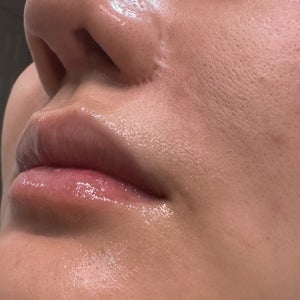 Scar revision post surgery - what would be the best options? (Photo)