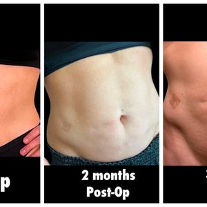 lipo c injection before and after 1 month Lipo-C Injections: The Ultimate Guide to Fat Burning & Energy main image 1