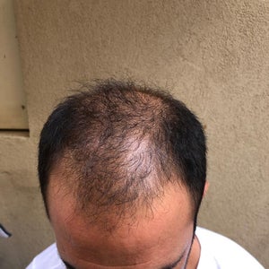 hair transplant reviews was it worth it realself hair transplant reviews was it worth