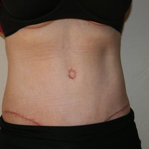 Belly Button Revision After Tummy Tuck