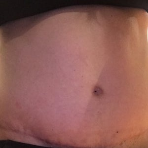 Belly button closed up after tummy tuck. I am still swollen or the