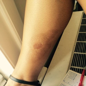 I Was Lightly Touched By An Exhaust Pipe While I Was Riding A Motorcycle What Can I Do To Make The Scar Lighten Up Photo